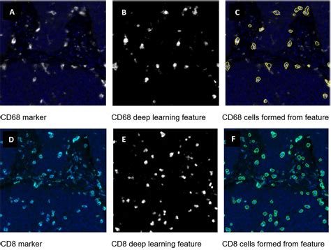 Spatial Phenotyping In Digital Pathology Defining A Multiplex IF Image