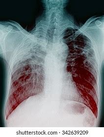 Film Chest Xray Show Cavity Right Stock Photo Shutterstock