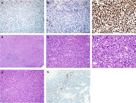 Smarca4 Deficient Thoracic Sarcoma A Distinctive Clinicopathological Entity With