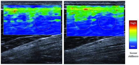 Shear Wave Elastography Swe Of The Ventral Thigh Before Left And 48 Download Scientific