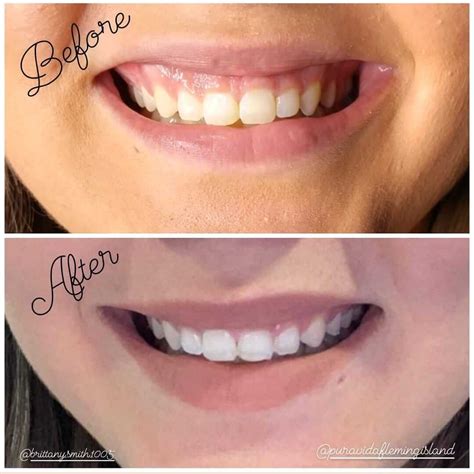 Gummy Smile Reduction With Neuromodulators