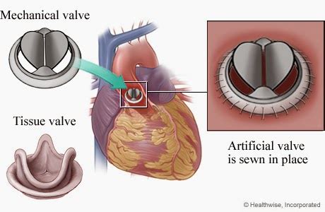 Medical Treatment Pictures-for Better Understanding: Aortic Valve ...