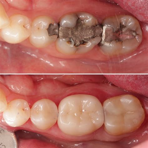 Proc And Cons Of Amalgam Fillings — Clean Teeth Dental