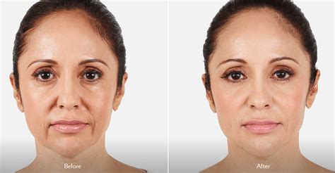 Vollure Filler For Lines And Wrinkles Dermatologist Dr Gergana