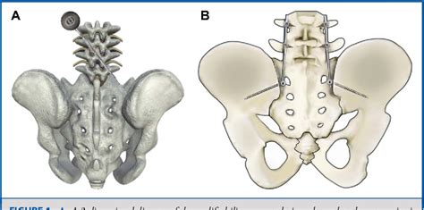 Figure From Modified Iliac Screw In Lumbopelvic Fixation After Sacral