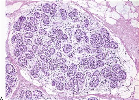 Lobular Carcinoma in Situ and Atypical Lobular Hyperplasia | Oncohema Key