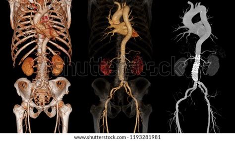 Cta Whole Aorta With Abdominal Aorta Stent Graft Compare 3d Rendering Image Vs Maximum Intensity