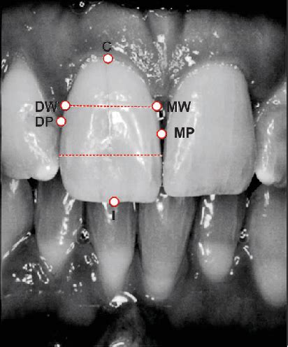 Figure 1 From Soft Tissue Development In The Esthetic Zone A Clinical