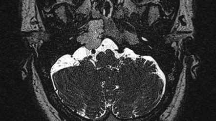 Petrous apex lesions (differential) | Radiology Reference Article ...