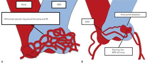 Ct Pulmonary Angiogram Showing Bilateral Segmental Pulmonary Emboli Download Scientific Diagram