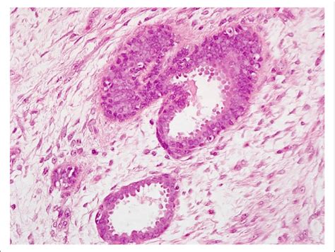 Pathology Benign Breast Epithelium Hande Stained Image Demonstrates