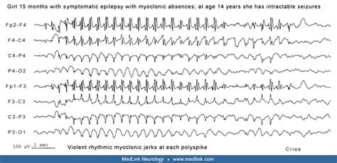 Generalized onset clonic seizures | MedLink Neurology