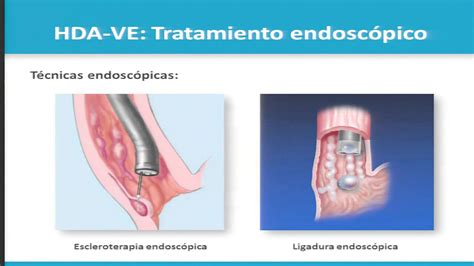 Varices Esofagicas Tratamiento Endoscopico Otras Opciones YouTube