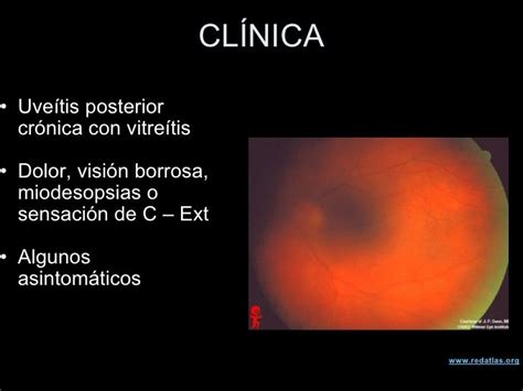 Linfoma Intraocular