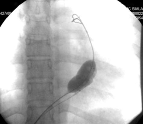 Balloon Dilatation With Two Balloons 23mm×40mm And 17mm×40mm