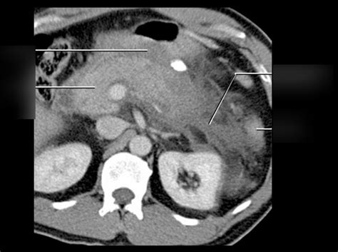 pancreas CT 2 - pancreatitis Diagram | Quizlet