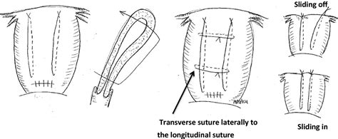 Uterine Compression Sutures For Postpartum Hemorrhage An Overview Matsubara 2013 Acta