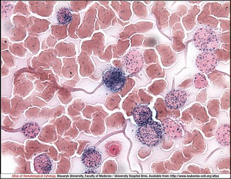 Acute monoblastic/monocytic leukaemia - CELL - Atlas of Haematological ...