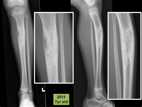 Osteosarcoma Arising In A Case Of Osteofibrous Dysplasia Of Tibia With