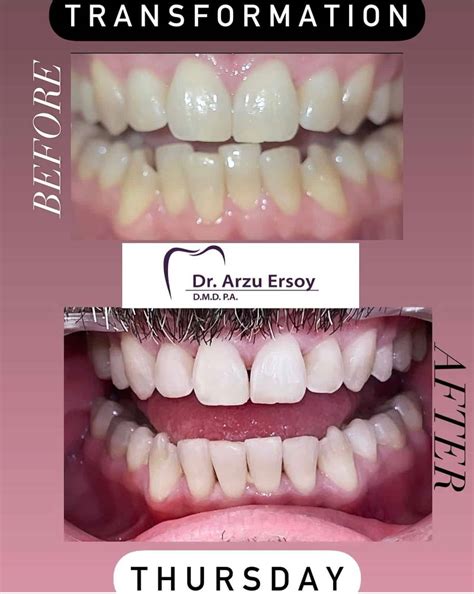 Clear Aligner Dentist in Panama City - Clear Braces | Arzu Ersoy, DMD, PA
