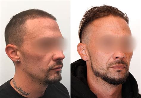 Beard Transplant Before And After Gallery Dr Cory Torgerson