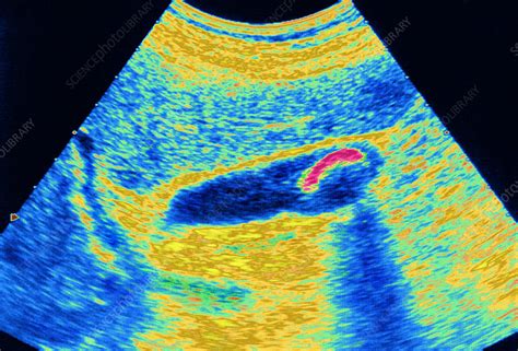 Gallstone Ultrasound Scan Stock Image M165 0312 Science Photo