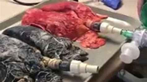 Pulmones De Fumador Vs Pulmones Sanos El Impactante Video Viral Infobae