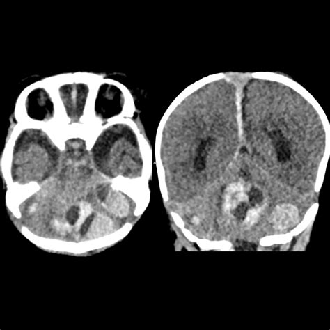 Pediatric Extracorporeal Membrane Oxygenation Pediatric Radiology