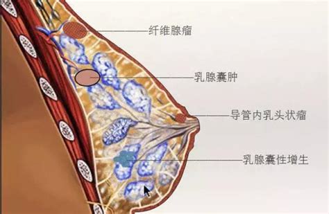 乳房腫塊≠乳腺癌，常見的腫塊類型你必須了解 每日頭條