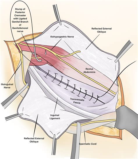 Primary Tissue Repair For Inguinal Hernias Surgical Clinics