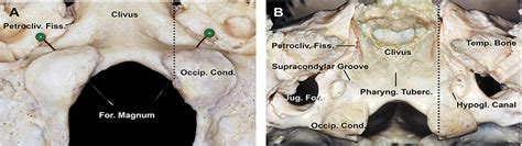 Endoscopic Endonasal Transclival Transcondylar Approach For