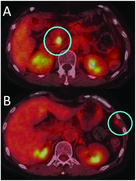 Positron Emission Tomography With 18 Fluorodeoxyglucose FDG PET