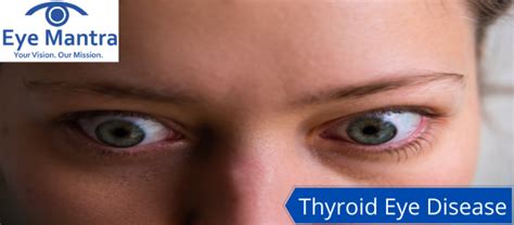 Thyroid Eye Disease Risks Symptoms Causes And Treatment Eyemantra