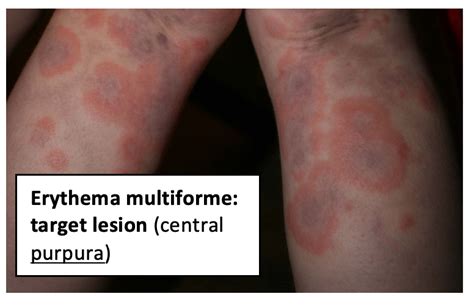 Erythema Multiforme Differential