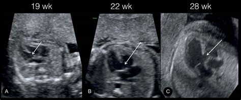 Atrial Ventricular And Atrioventricular Septal Defects Obgyn Key