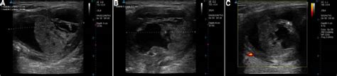 Neck Ultrasonography 1 Month After Ethanol Ablation A And B