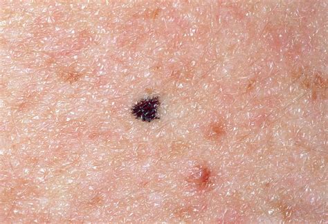 Close-up Of A Benign Mole On Skin Of Young Man Photograph by Dr P ...