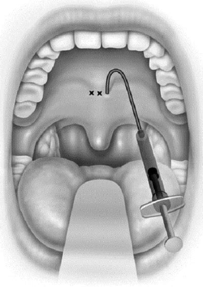 Sleep Apnea Surgery in Iran | Somnoplasty, UPPP Surgery