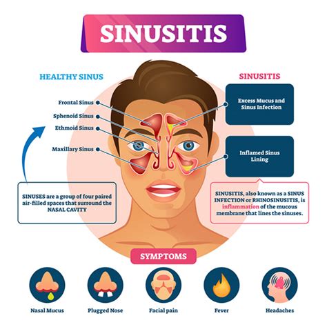 Can Sinus Pressure Cause Neck Pain? All You Need to Understand