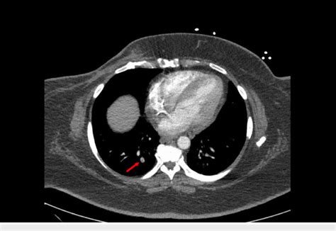 Ct Scan Showing A Small Right Lower Lobe Pulmonary Embolus Download Scientific Diagram