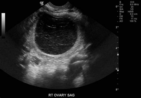 Hemorrhagic Cyst Ultrasound