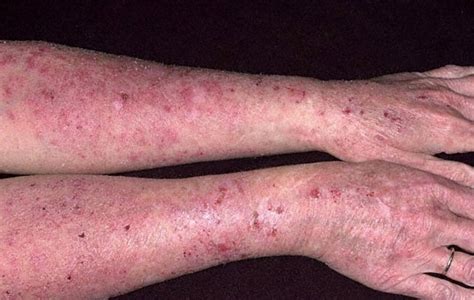 Eczema Pictures: What does Eczema look like?