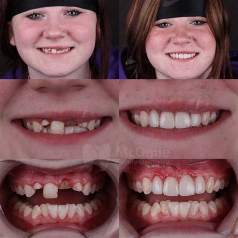 Dental Bridge Front Teeth Before And After