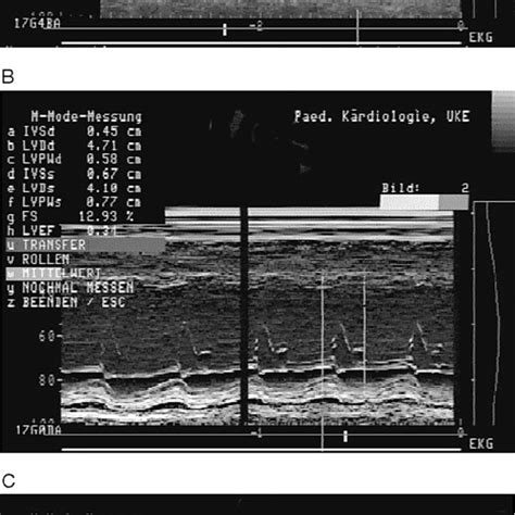 A Preoperative Echocardiography Parasternal Long‐axis View M‐mode