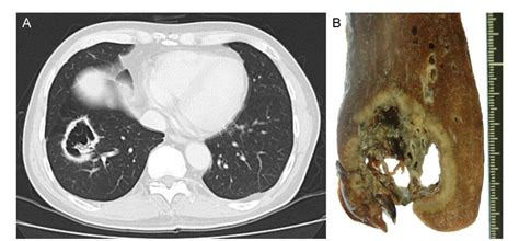 [PDF] Cavitary Lung Cancer Lined with Normal Bronchial Epithelium and Cancer Cells | Semantic ...