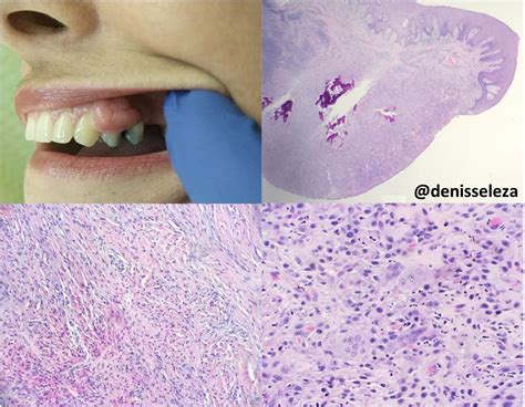 Peripheral Giant Cell Granuloma Vs Pyogenic Granuloma