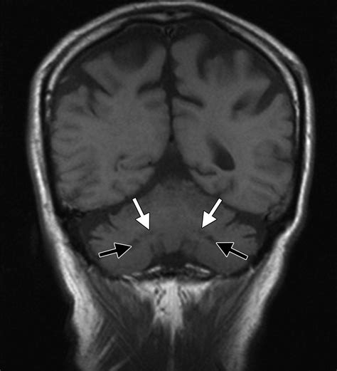 Case 239 Cerebrotendinous Xanthomatosis Radiology