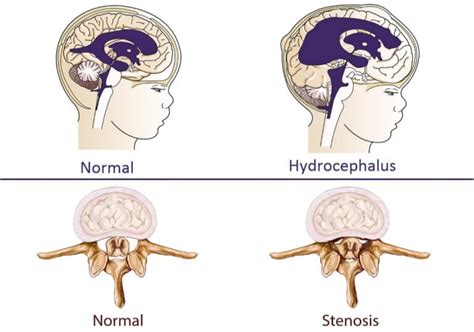 Achondroplasia Causes Signs Standard Therapies Prevention In