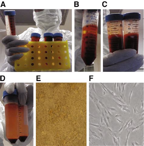 Isolation Of Stromal Vascular Fraction Svf From Patient S