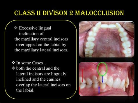 Class Ii Malocclusion